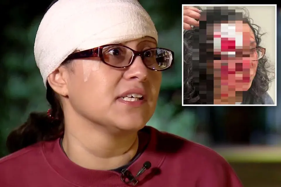 Seattle woman's forehead bitten off in random 'zombie' attack, suspect jailed