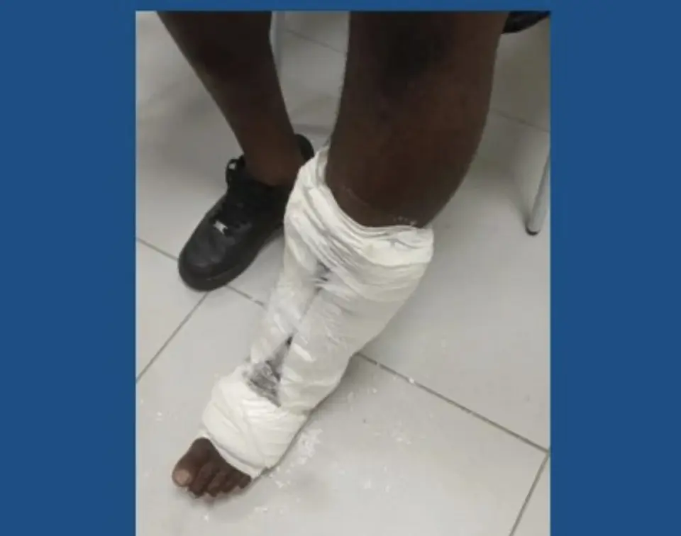 Arrest at Lamentin airport: 3 kg of cocaine hidden in fake plaster cast